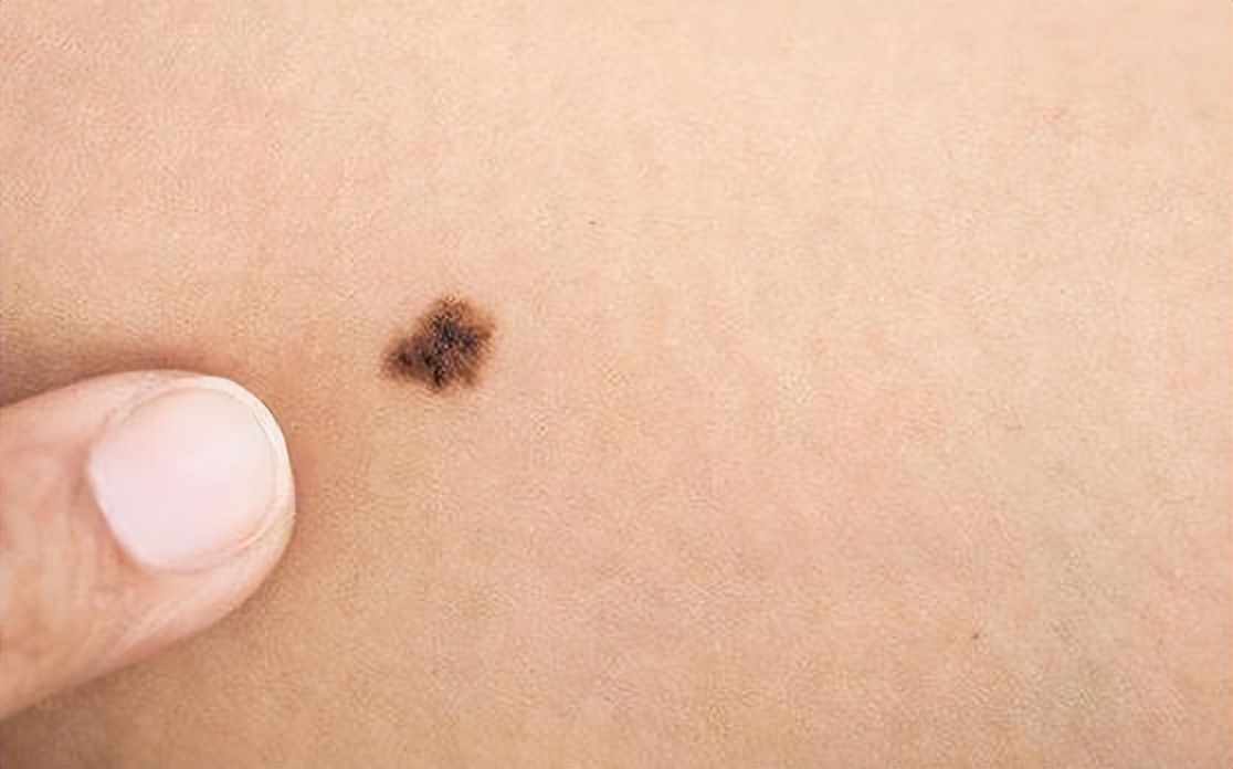 黑痣上长毛是好痣还是坏痣,脸上有个凸出的黑痣是好痣吗