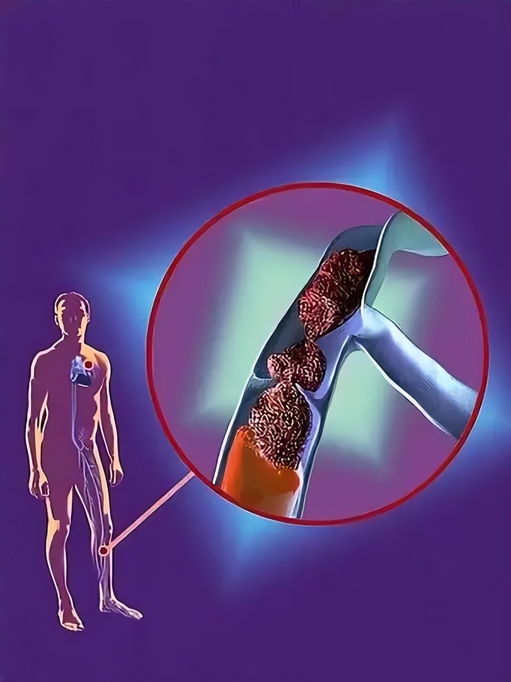 70岁动脉夹层第一层破裂能活多久,老人80了心脏动脉夹层破裂有救吗