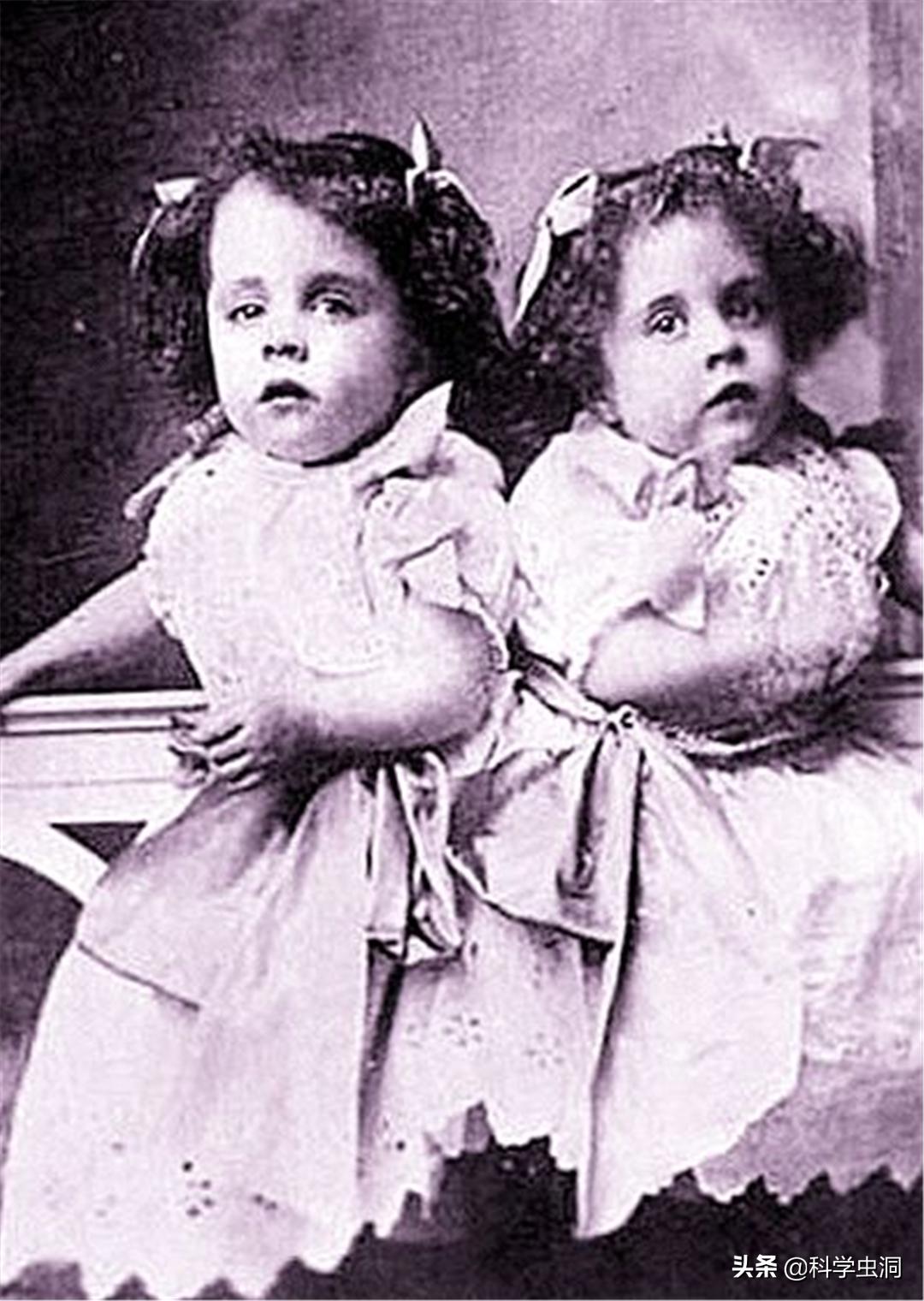 连体姐妹其中一个人死了怎么办,连体姐妹一个死了另一个咋办