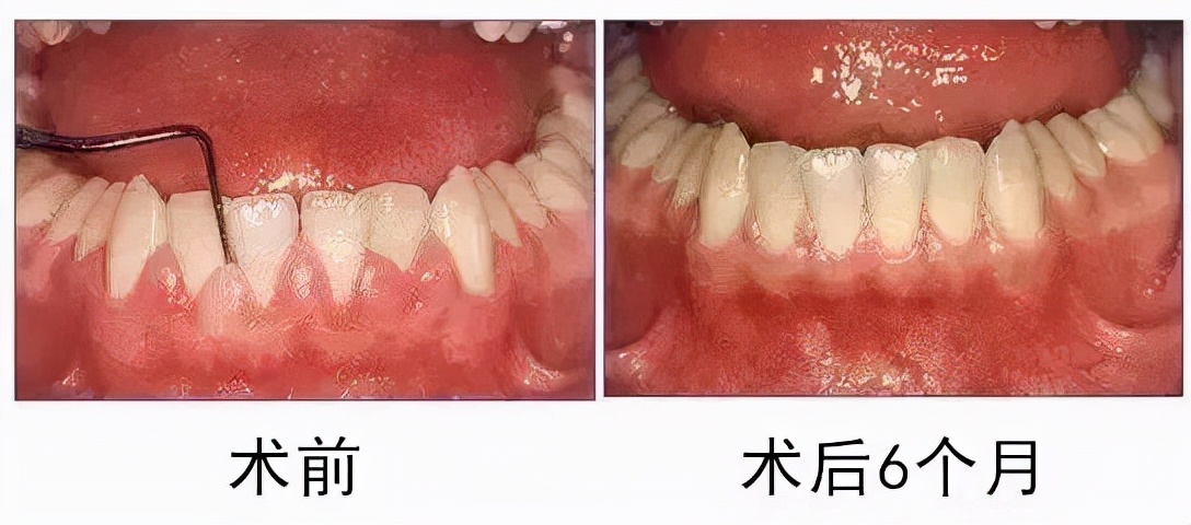 补牙后牙龈反复长脓包可以不理吗,牙龈的脓包可以挤掉吗