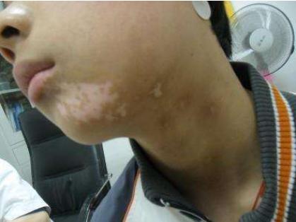 孩子脸上有白斑吃什么打虫药,小孩子脸上长白斑需要吃打虫药吗