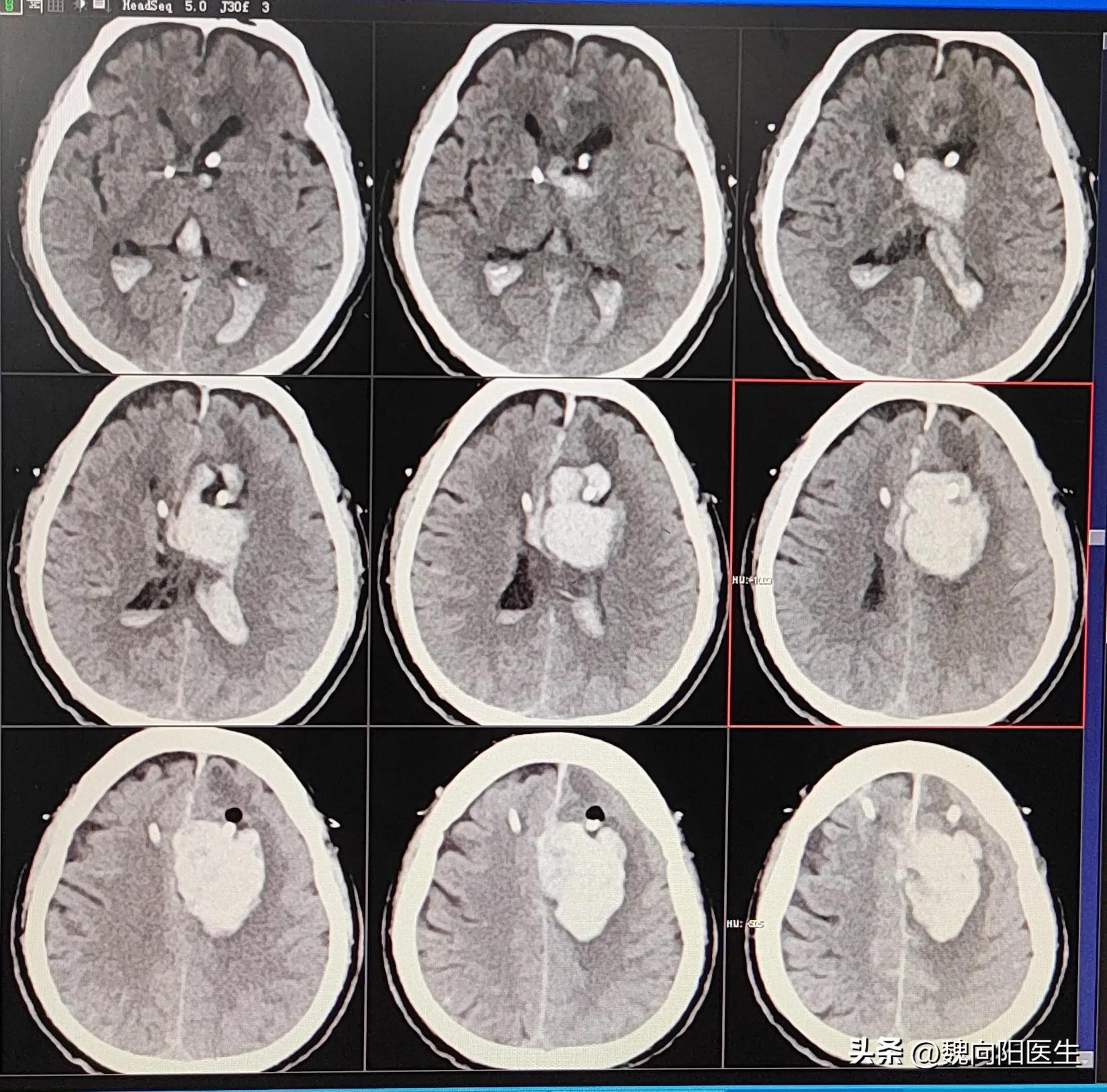长期给患者吃华法林，引起脑出血。家属很后悔，是不是吃错了？