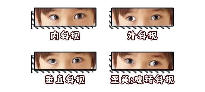 上海儿童斜视手术专家：孩子学龄前，发现斜视要及时治疗