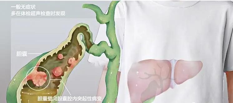 胆囊切除后对人体影响很大,胆囊切除对人体器官影响大吗