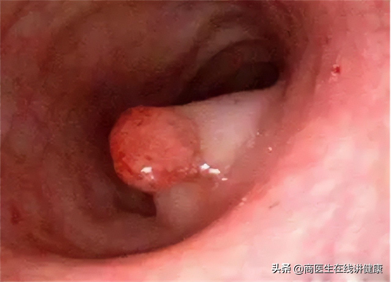 为什么会有肠道息肉,为什么肠道会长息肉