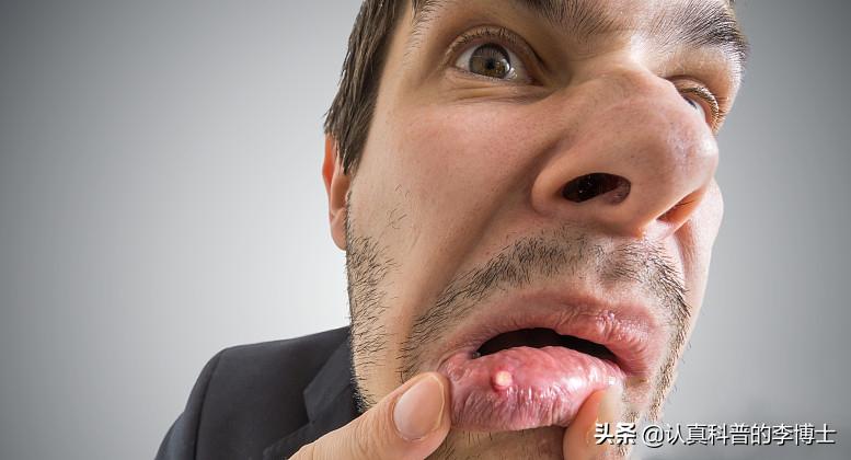 口腔溃疡用维c真的有用吗,口腔溃疡反复发作补什么维生素