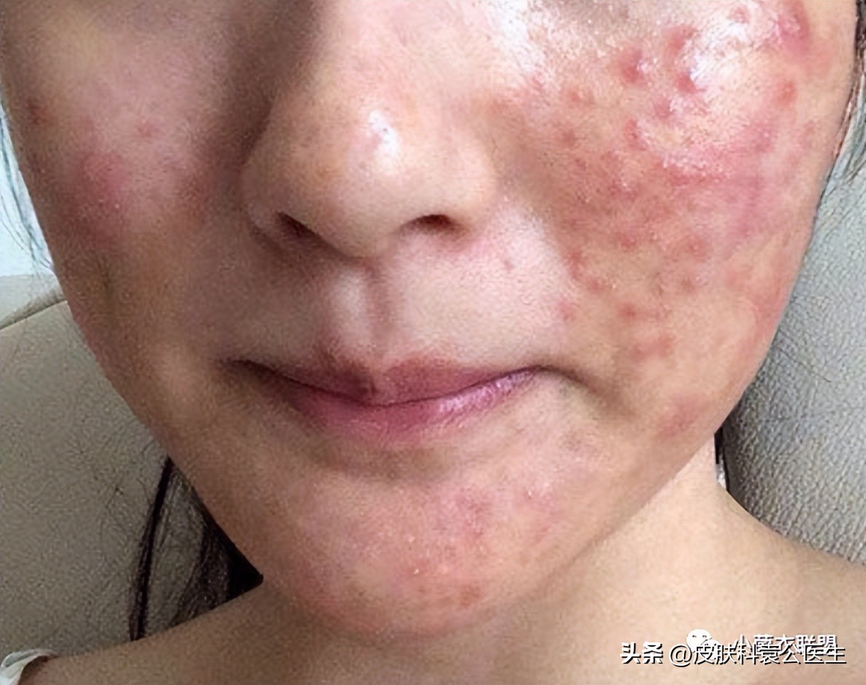 皮肤病忌口发物都包括牛奶吗,发物忌口期间吃什么比较好