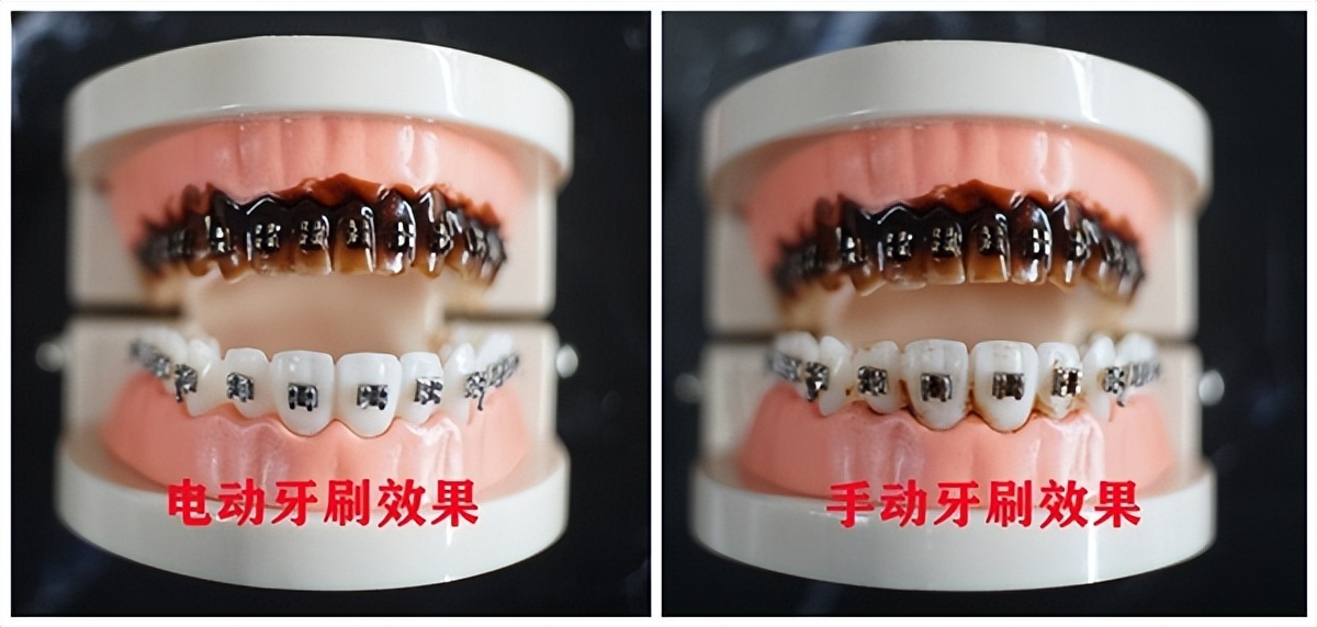 婴幼儿牙刷手动的好还是电动的好,6岁小孩牙刷是电动的好还是手动