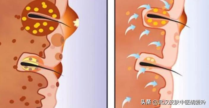 痘痘有白色脓点用什么药膏,痘痘里有硬块不冒脓怎么办