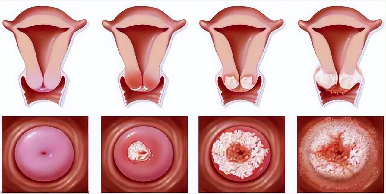 宫颈癌初期没有任何症状吗,宫颈癌早期会有明显的疼痛感么