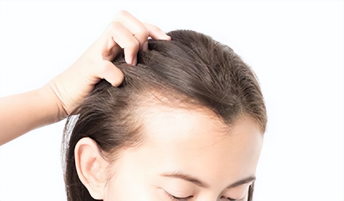脱发为什么都是从头顶先秃,脱发为什么先从头顶脱