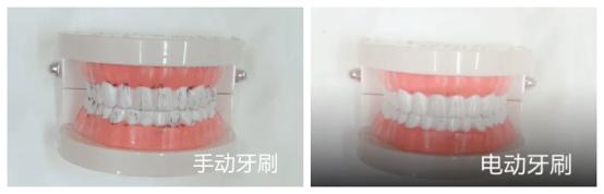 长期使用电动牙刷的危害弊端,usmile和欧乐b电动牙刷哪个好