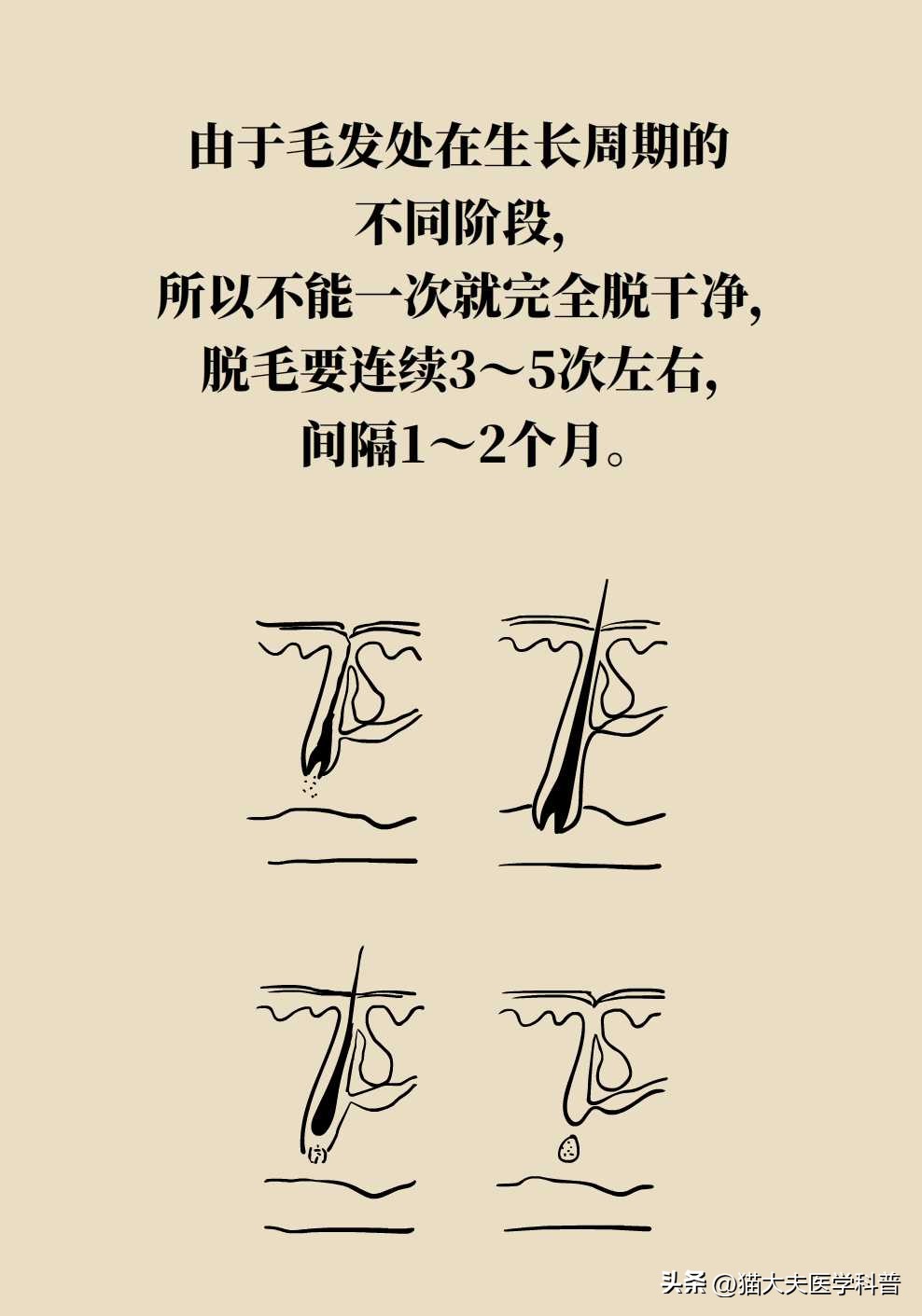 opt激光脱毛是永久的吗,激光男士脱毛永久简单方法