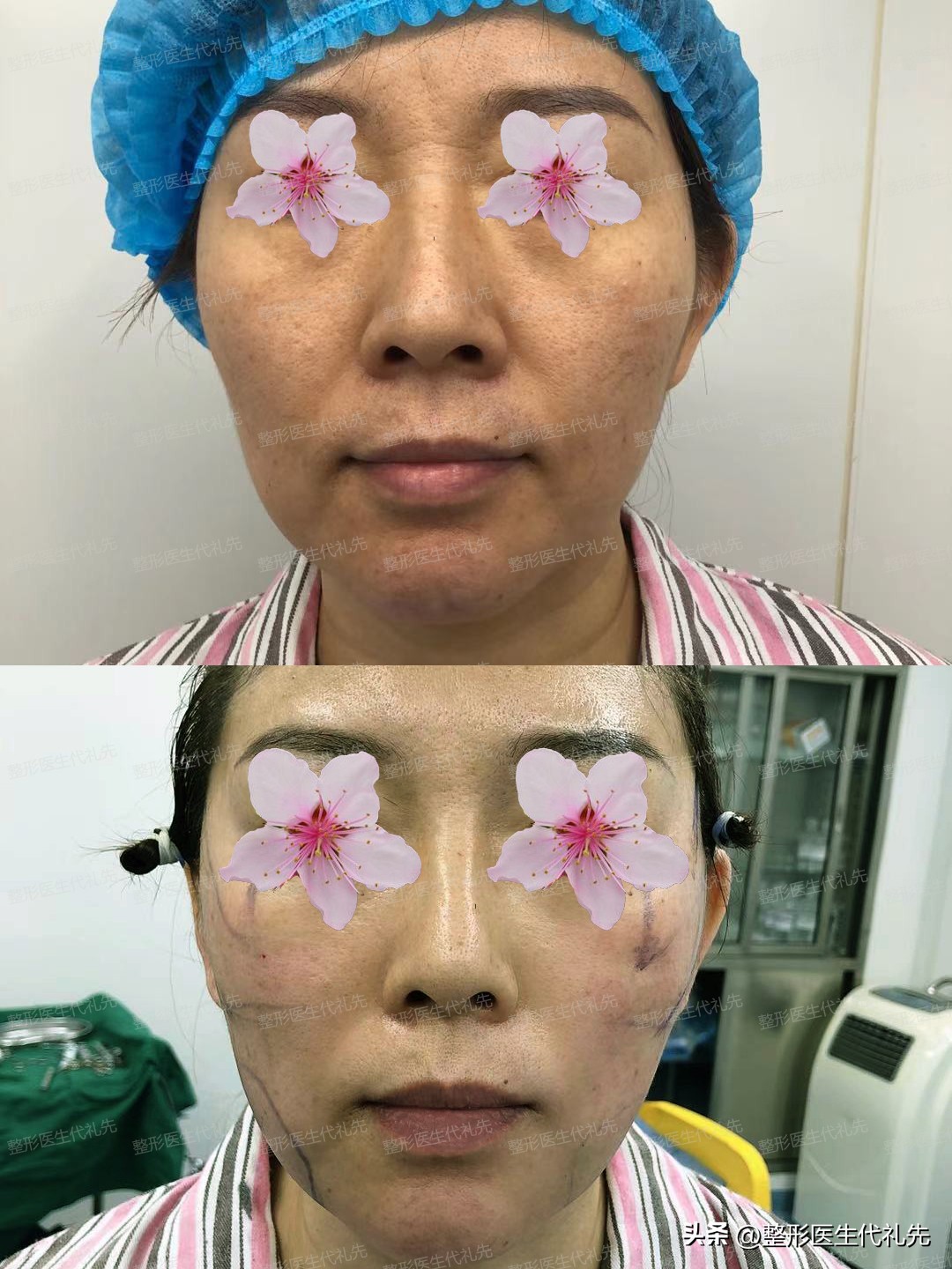 太阳穴凹陷怎么造成,太阳穴和脸颊突然凹陷的原因