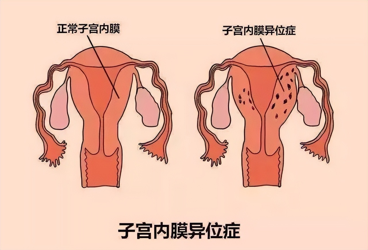 未婚得妇科病几率大吗,未婚能避免做妇科检查吗