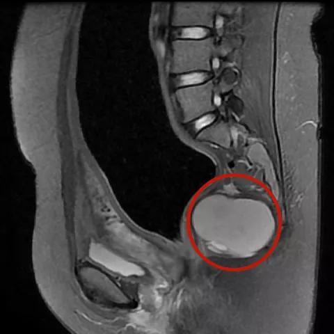便便从阴道里出来？20多岁的她面临的问题不止如此……