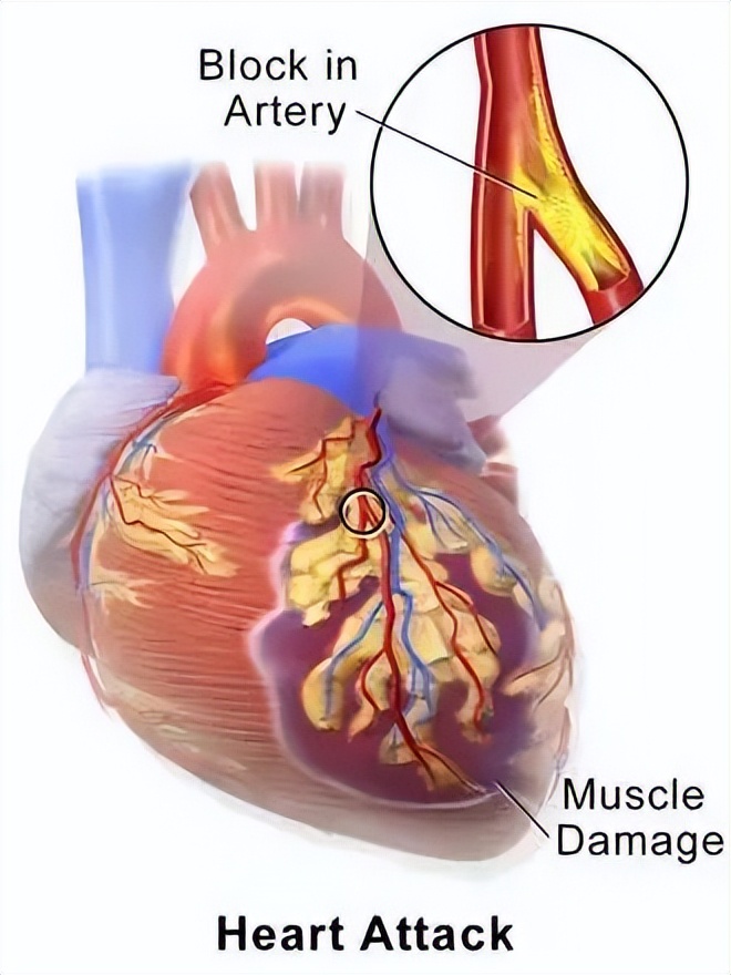 心脏病突发足球,看球心脏有不舒服