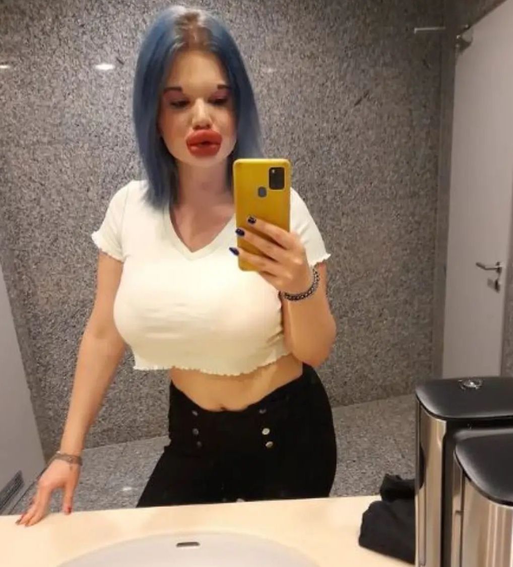 女子狂打30支玻尿酸,丰唇针建议打吗