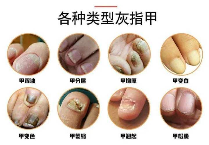 灰指甲怎样才能彻底根除用什么药,脚上灰指甲怎么才能彻底根治