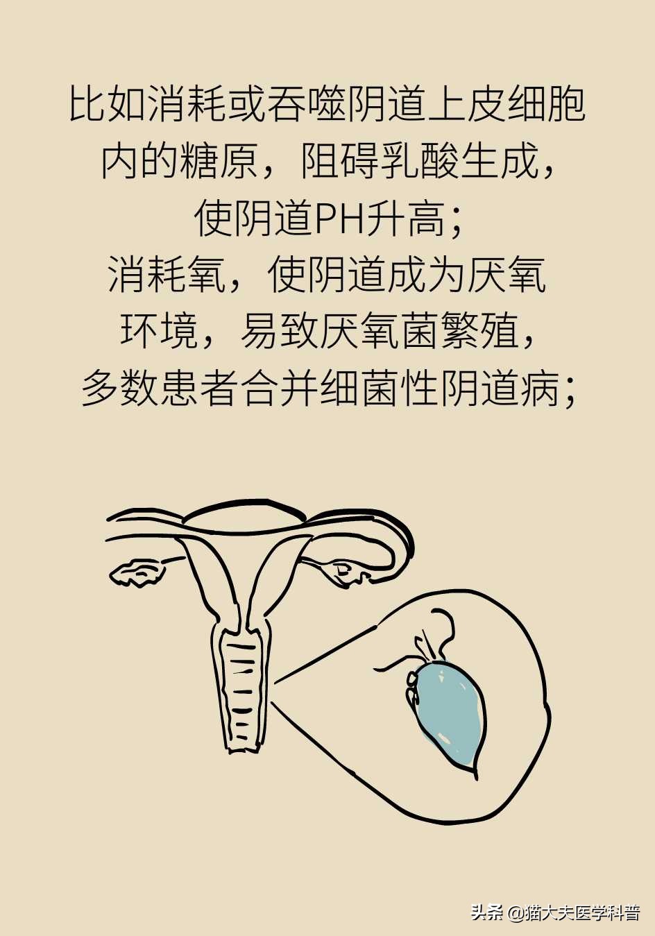 滴虫性阴道炎会不会没有症状,滴虫性阴道炎的症状会传染吗