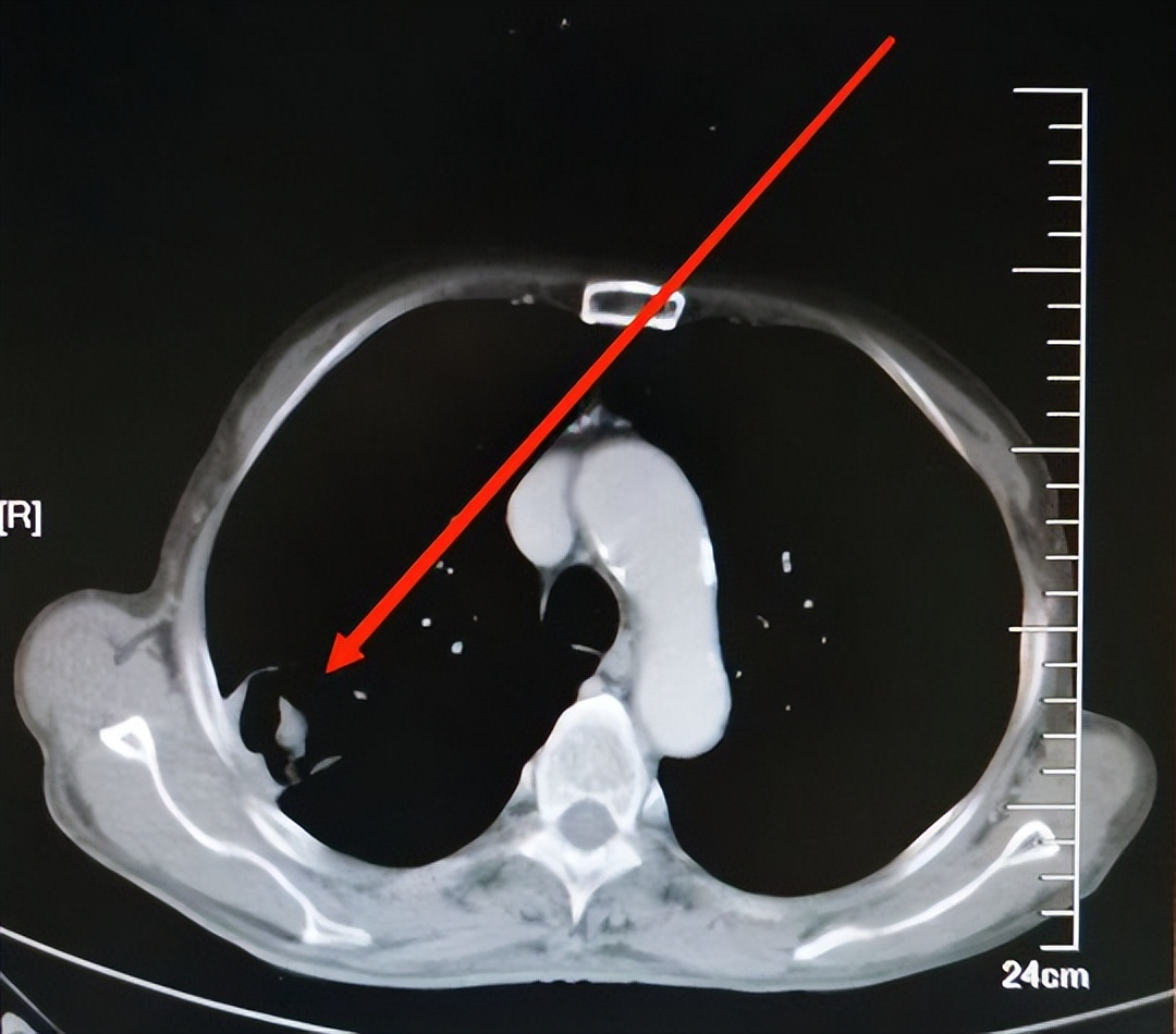 肺癌化疗后又恶化,肺癌化疗后明显缩小会复发吗