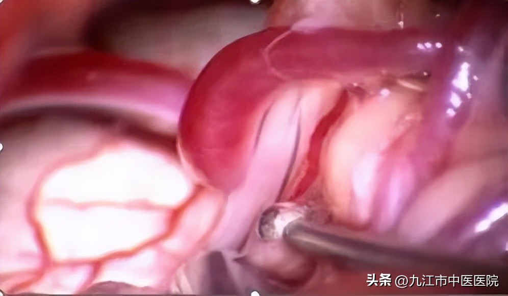 面肌痉挛微血管减压术恢复期,面肌痉挛面神经减压术