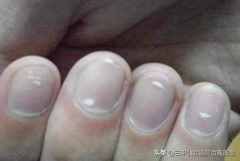 手指甲出现横纹预示身体怎样,手指甲有凹凸竖纹正常生理现象