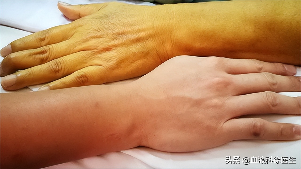 胆管癌的早期4大症状是什么呢,发现胆管癌要注意这4点