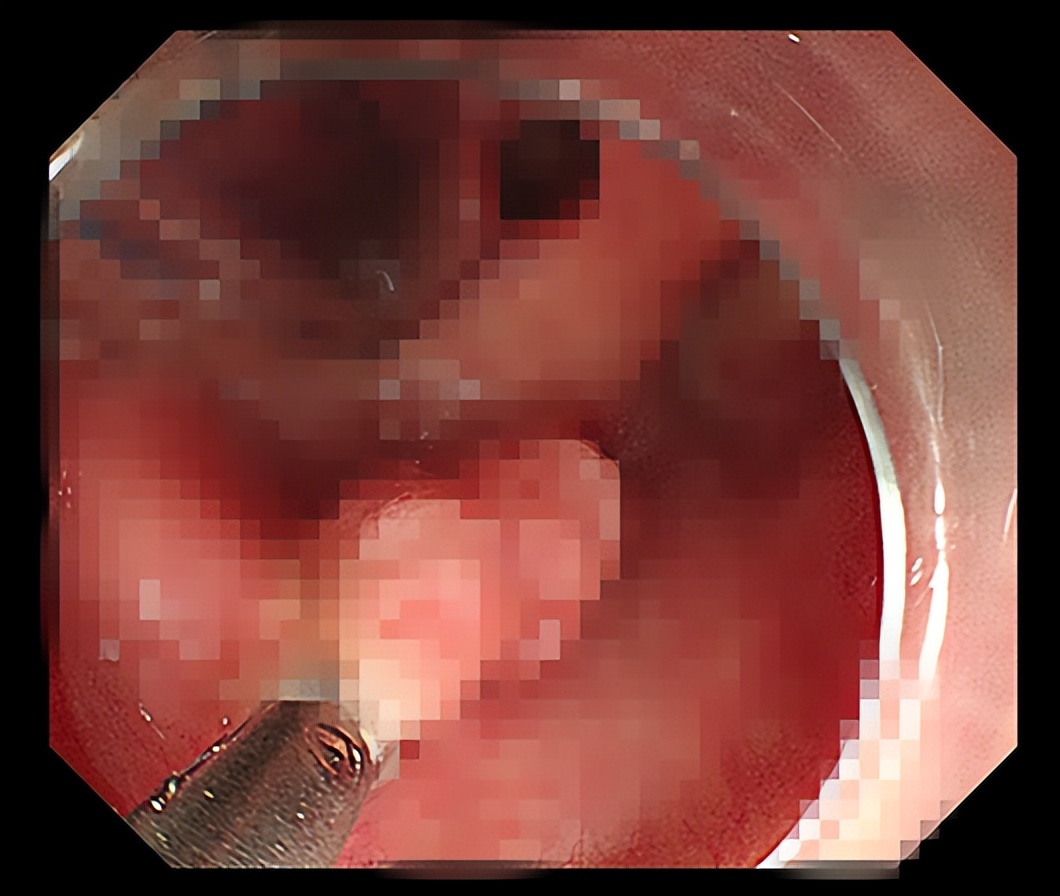 受益于早诊、早治的“幸运儿”