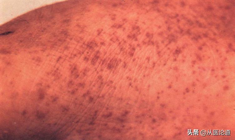 免疫性血小板减少性紫癜itp,血小板减少性紫癜紫斑消失慢