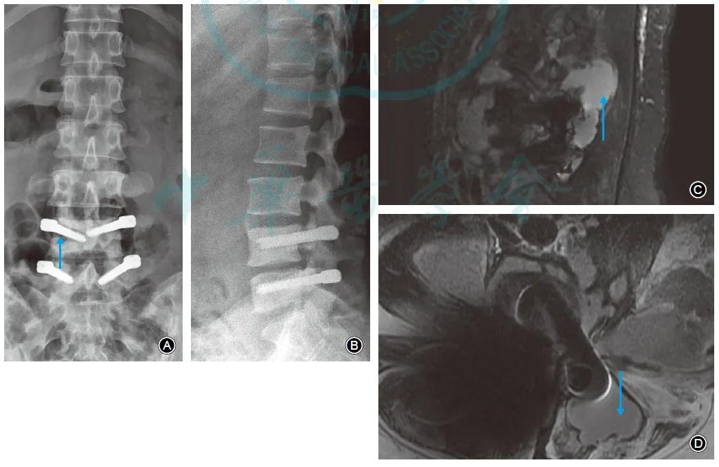 腰椎术后感染原因分析,腰椎管微创术后感染
