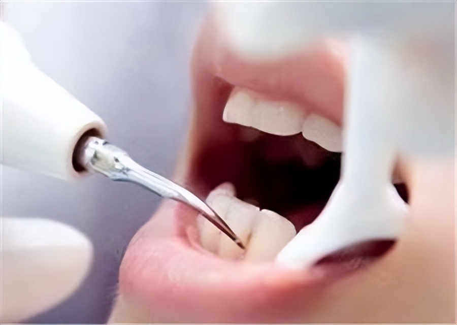 牙结石能直接抠下来吗,牙结石用手可以抠掉吗