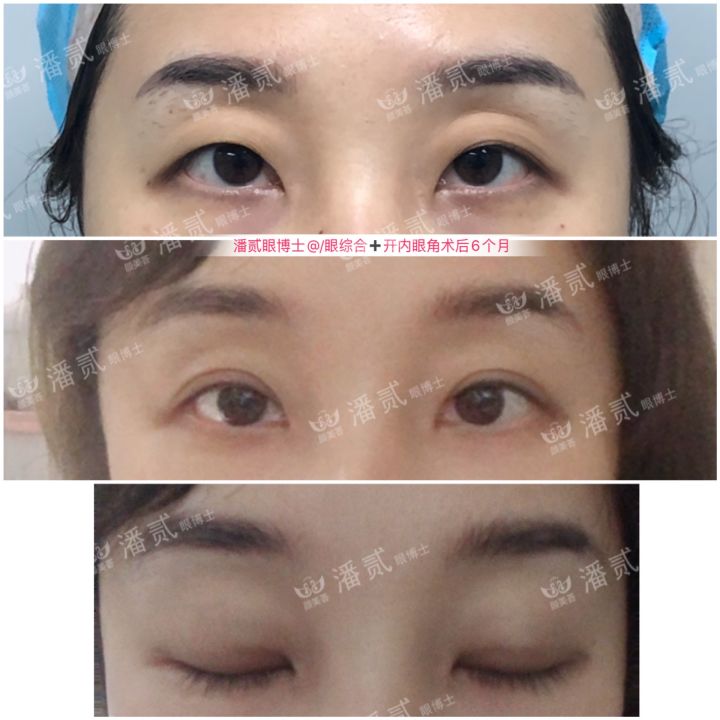 凸眼球显得眼睛大,凸眼眼窝凹陷