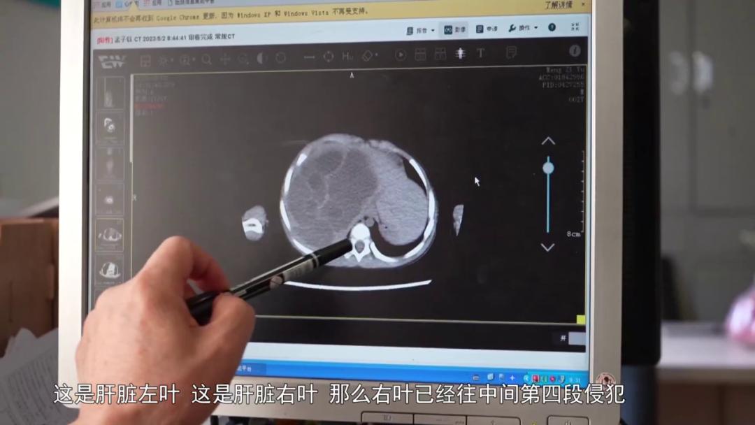 儿童肝脏错构瘤是什么原因引起的,两个月的宝宝肝上面有血管瘤