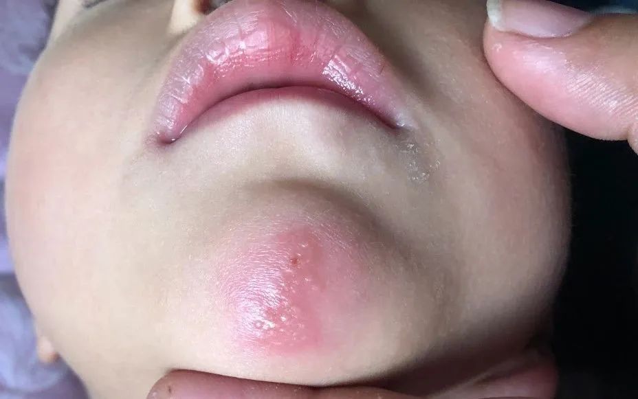 口唇边疱疹最好的治疗方法,口周疱疹