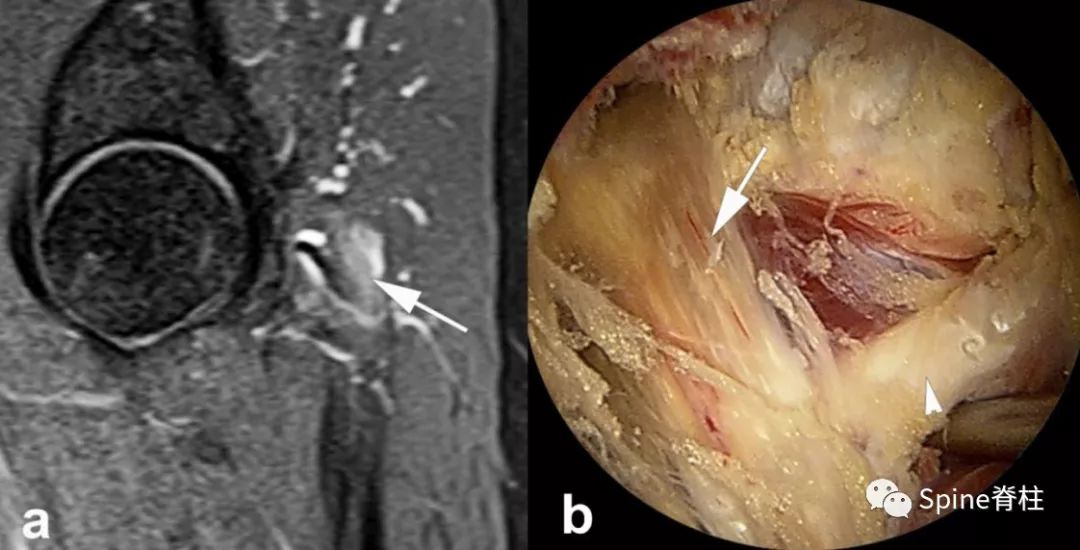 腰椎间盘突出下肢放射痛严重吗,下肢放射疼痛是间断性严重吗
