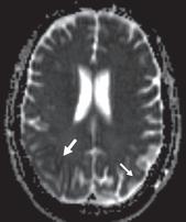 脑水肿的影像,脑水肿形成机制生理学