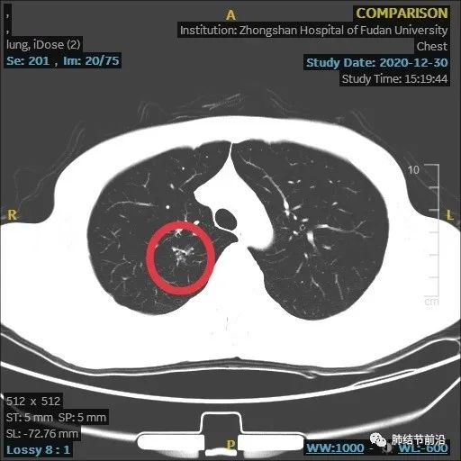 炎症引起的肺实性结节生长速度,肺部结节影像学读片讲解视频