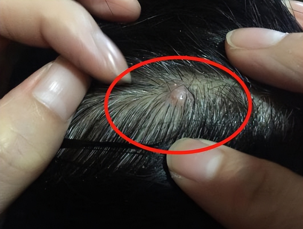 头皮总长疙瘩和脓包是怎么回事,头皮老是长疙瘩有脓包怎么办