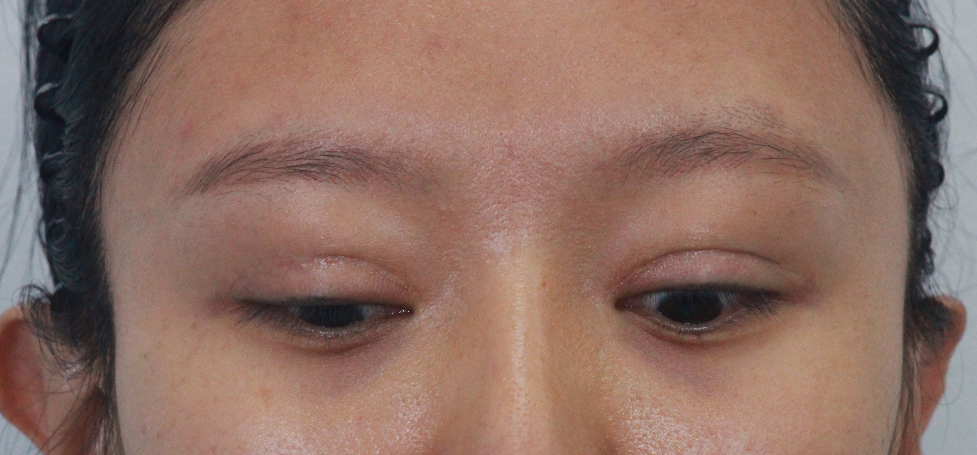 双眼皮修复新乡,姑娘眼部整形后双眼皮变三眼皮