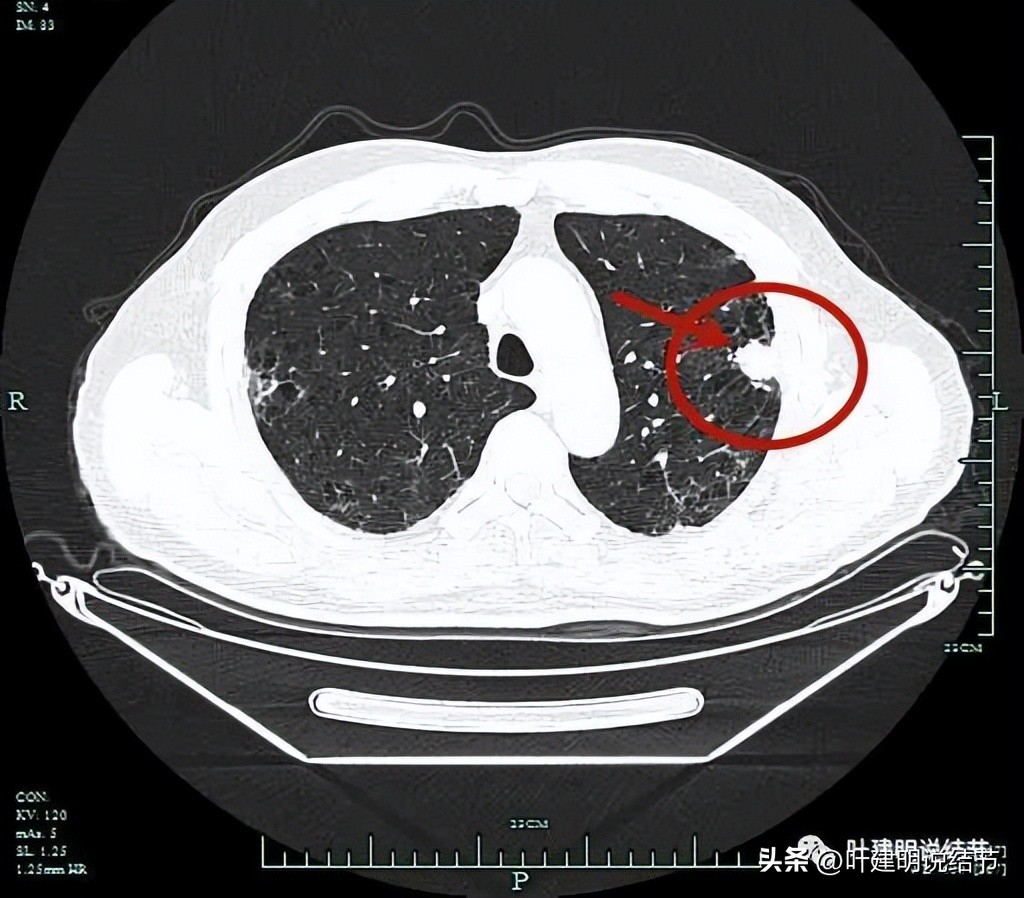 pet判断淋巴结转移,petct判断癌有没有转移准确吗