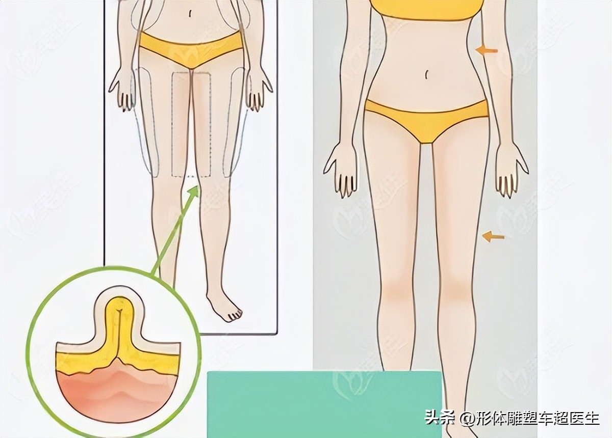 吸脂手术失败要怎么要求赔偿,大腿吸脂什么样的算是失败