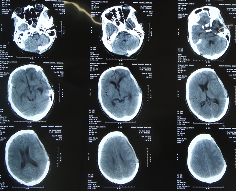 脑外伤开颅手术后继发癫痫,开颅术后颅内感染