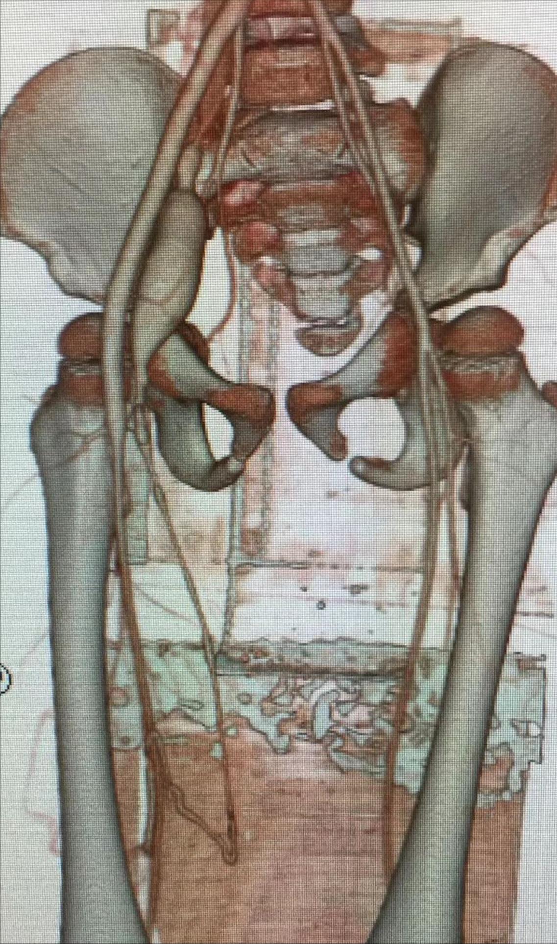 血管畸形伴大静脉瘤扩张,下肢动静脉畸形介入治疗