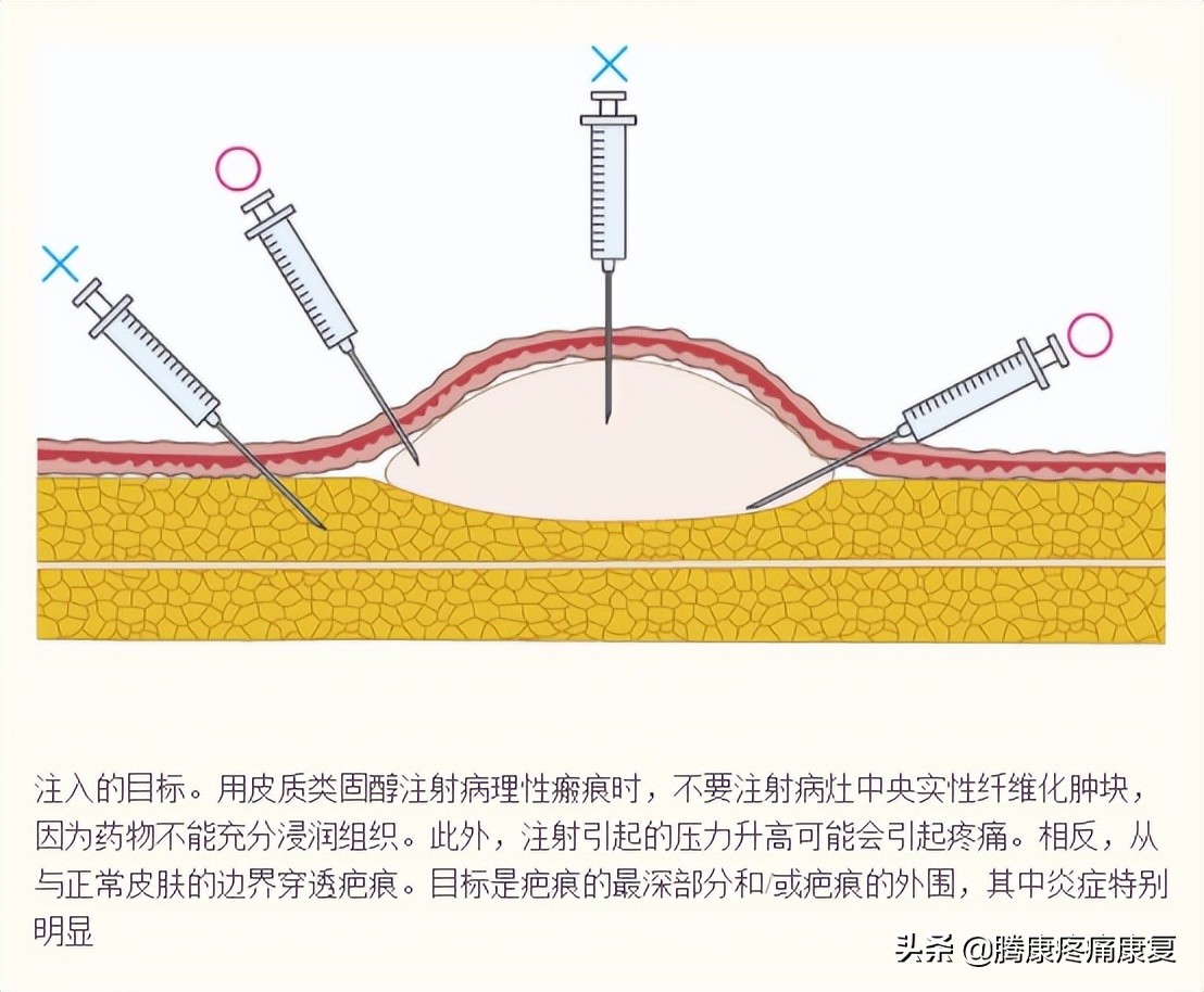 增生性瘢痕和瘢痕疙瘩的鉴别诊断,皮质类固醇贴
