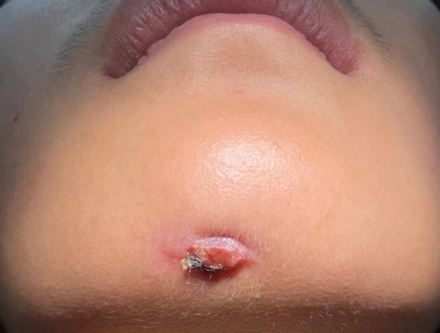 口腔牙龈内壁长硬包是上火吗,牙龈肿痛上火有个脓包怎么办