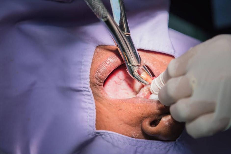 智齿拔掉的全过程,智齿太折磨人了怎么办