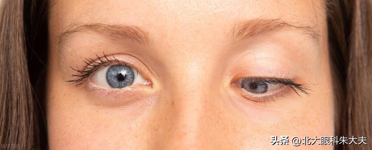 斜视手术会造成眼睑下垂吗,眼睑下垂会导致眼球下陷吗