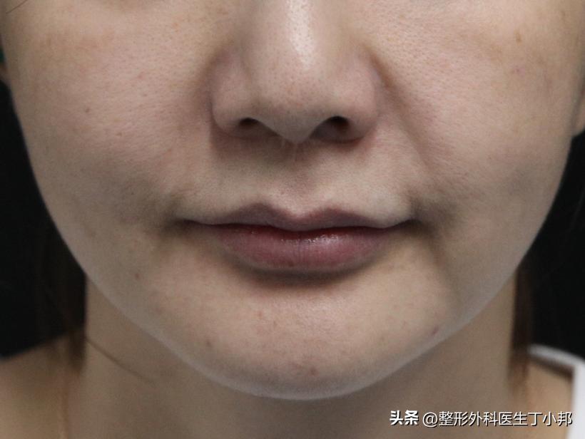 法令纹填充移位案例,法令纹爆炸线几天恢复