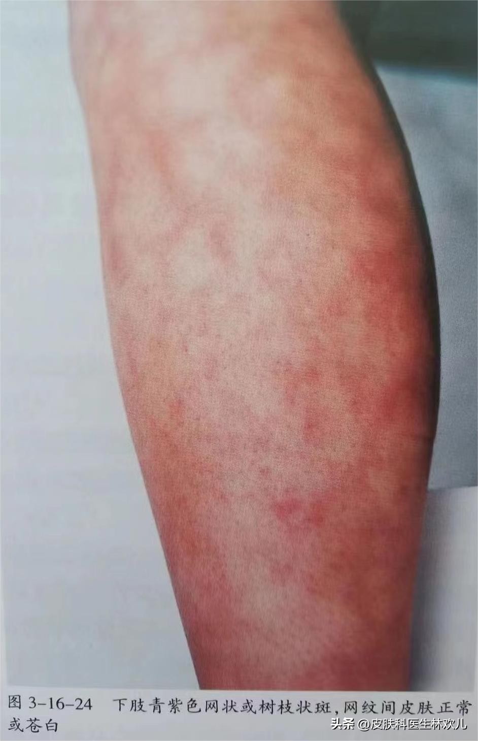 新冠期间皮肤瘙痒红斑咋回事,新冠皮肤痒怎么回事